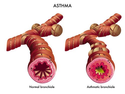 Krankheitsbild Asthma