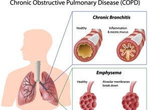 Infografik Lungenkrankheit COPD
